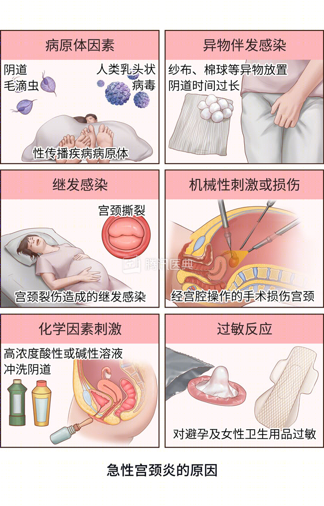 宫颈为何爱生病？4 个保护宫颈的方法，女生都该了解