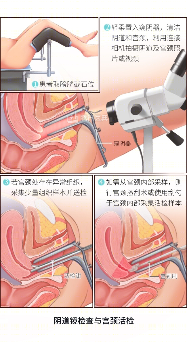 宫颈为何爱生病？4 个保护宫颈的方法，女生都该了解