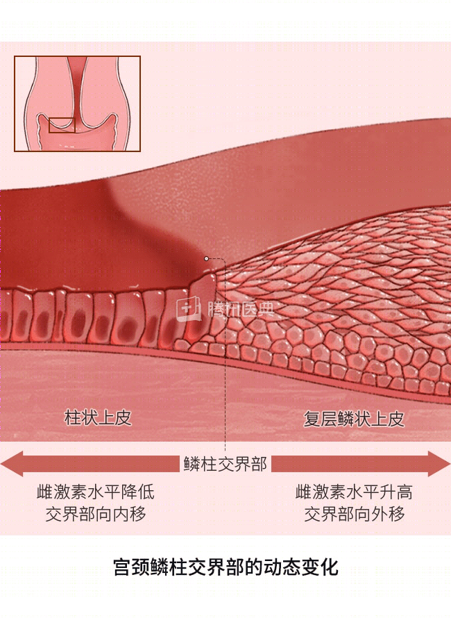 宫颈为何爱生病？4 个保护宫颈的方法，女生都该了解