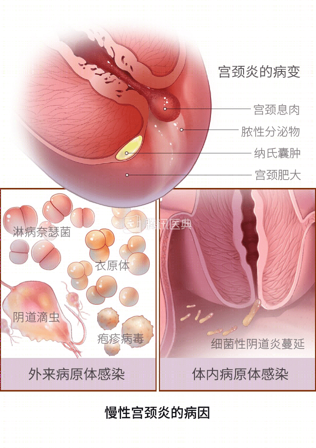 宫颈为何爱生病？4 个保护宫颈的方法，女生都该了解