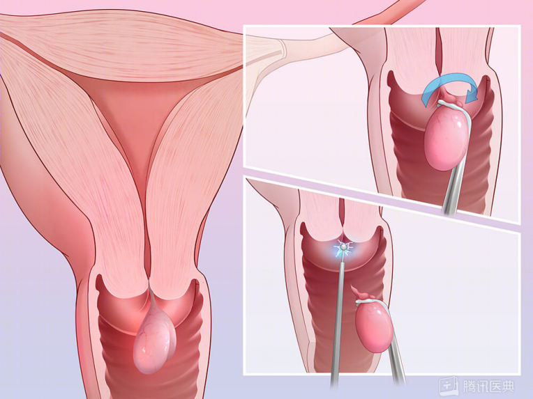 宫颈为何爱生病？4 个保护宫颈的方法，女生都该了解